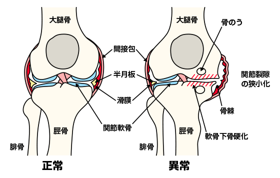 正常な膝関節と変形性膝関節症イメージ