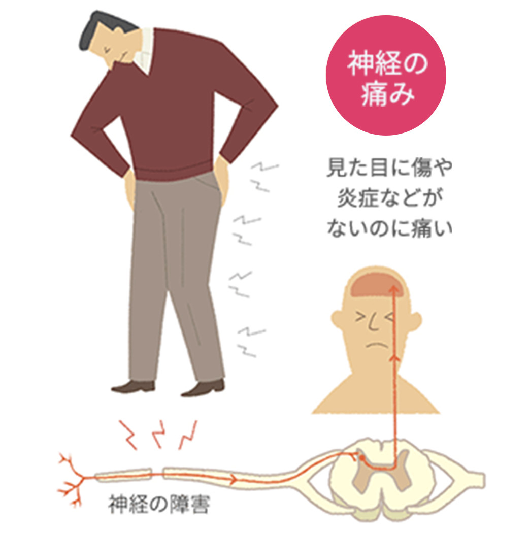 痛みの情報サイト 疼痛 とうつう Jp ヴィアトリス