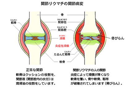 関節リウマチの関節病変イメージ