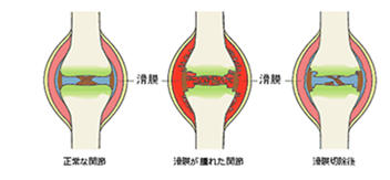 滑膜切除術イメージ