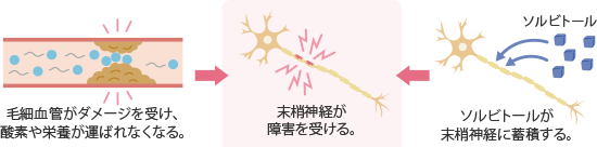 糖尿病性神経障害のイメージ