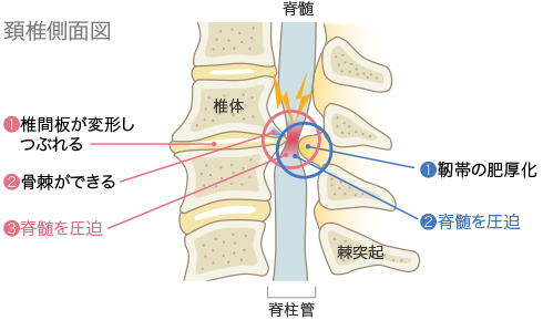 頚椎症性脊髄症イメージ