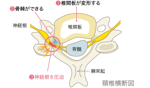 頚椎症性神経根症イメージ