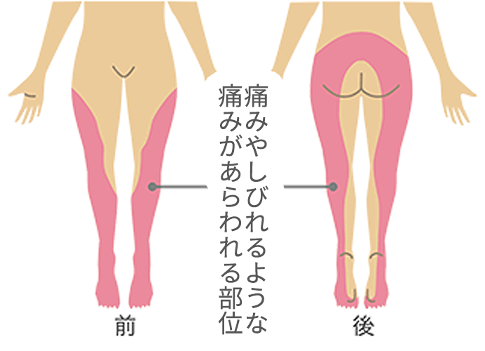 痛みの部位イメージ