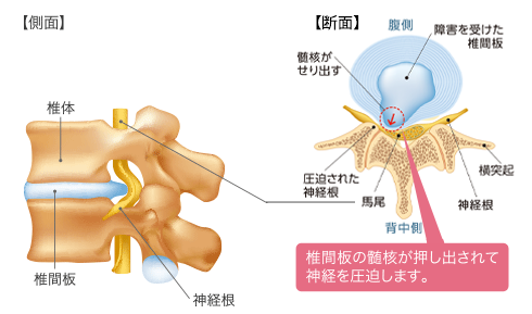 腰椎椎間板ヘルニアイメージ　側面・断面図